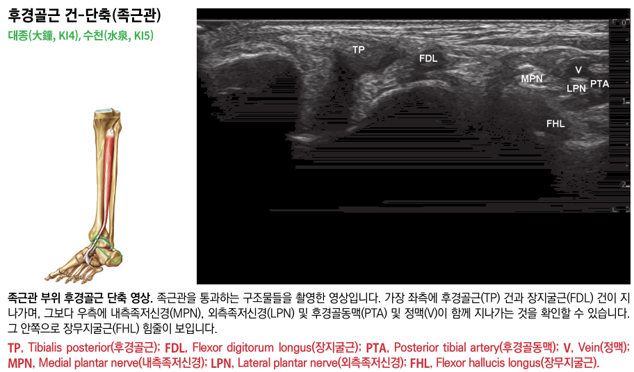 발목 족근관 부위의 해부학적 그림과 후경골근 건, 장지굴근 건, 내측족저신경, 외측족저신경, 후경골동맥, 정맥, 장무지굴근 힘줄이 보이는 초음파 영상.