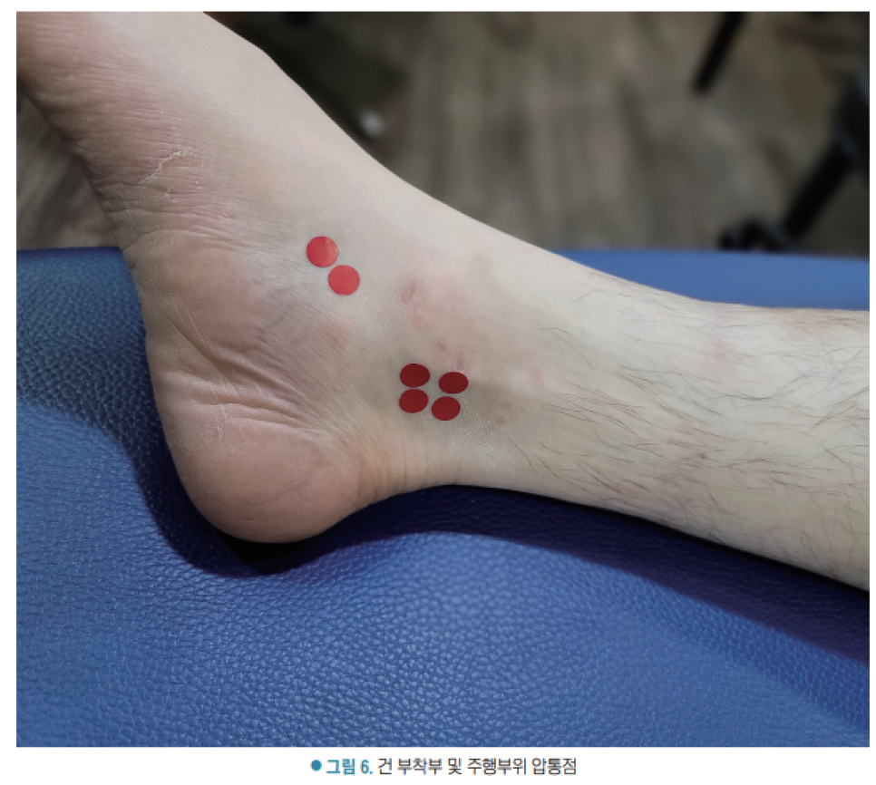 발목 안쪽에 빨간색 원형 스티커로 표시된 압통점들