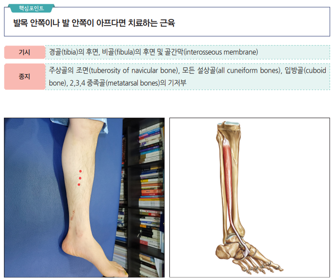 발목 안쪽 통증 치료를 위한 다리 혈자리와 후경골근 해부학적 그림.