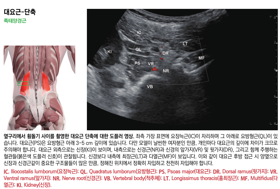 대요근의 해부학적 위치를 나타내는 인체 모형과 대요근, 신장, 신경근 등 주변 구조물과 혈류가 표시된 초음파 도플러 영상