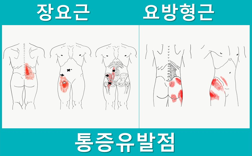 장요근과 요방형근의 통증 유발점과 방사통 부위를 표시한 인체 그림 — 서울 바로한의원 초음파 약침·도침