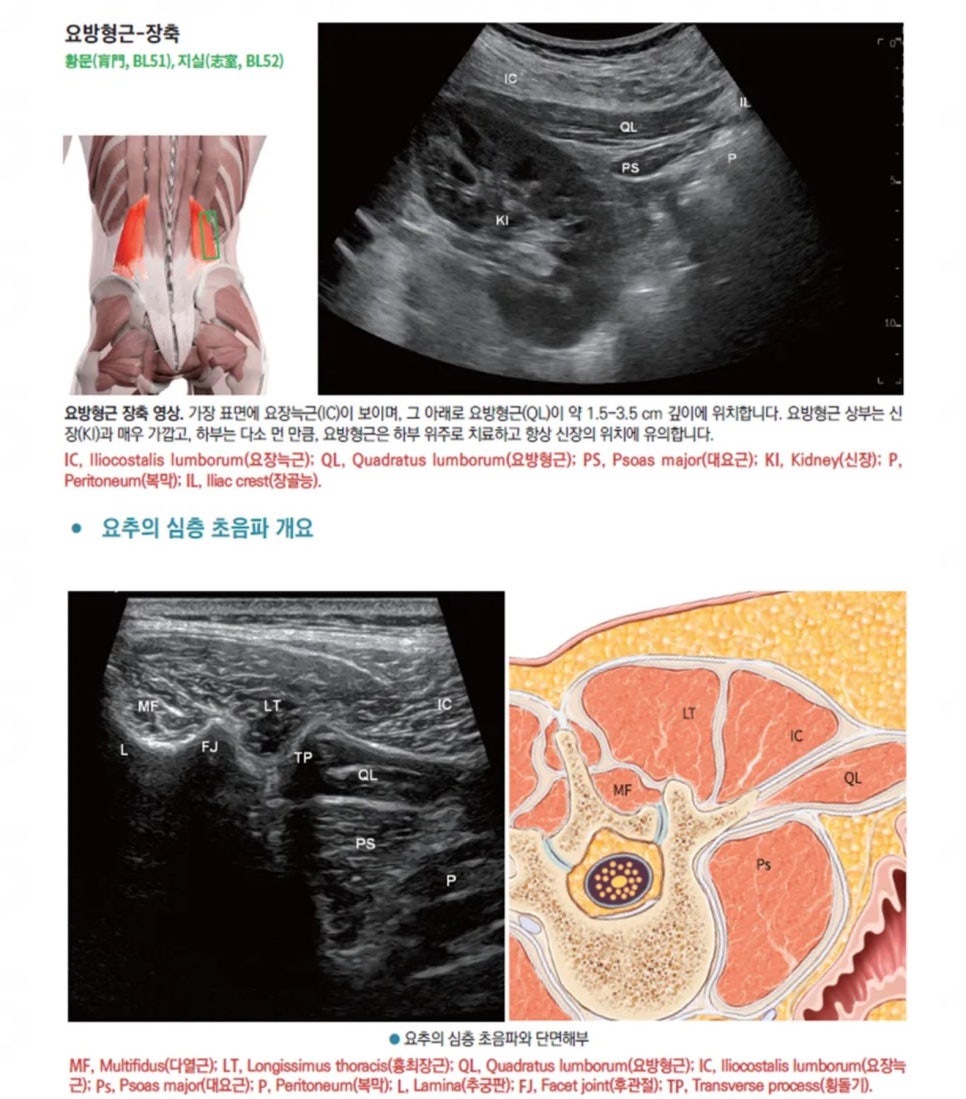 요방형근과 요추 심층 근육의 해부학적 그림 및 초음파 이미지 — 초음파 정밀 진단 | 서울 바로한의원 초음파 약침·도침·침도