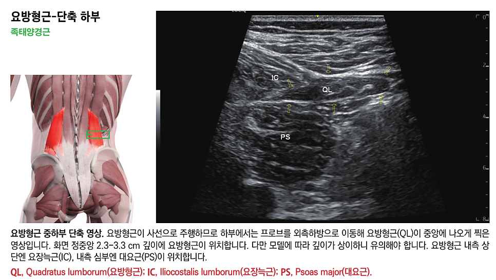 요방형근의 해부학적 그림과 요방형근, 요장늑근, 대요근이 표시된 초음파 영상.
