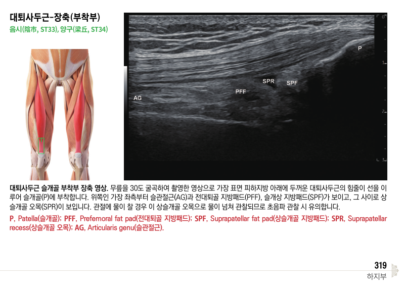 대퇴사두근의 슬개골 부착부 해부학적 그림과 무릎을 30도 굴곡하여 촬영한 초음파 영상. 초음파 영상에는 슬관절근, 전대퇴골 지방패드, 슬개상 지방패드, 상슬개골 오목이 표시되어 있다.