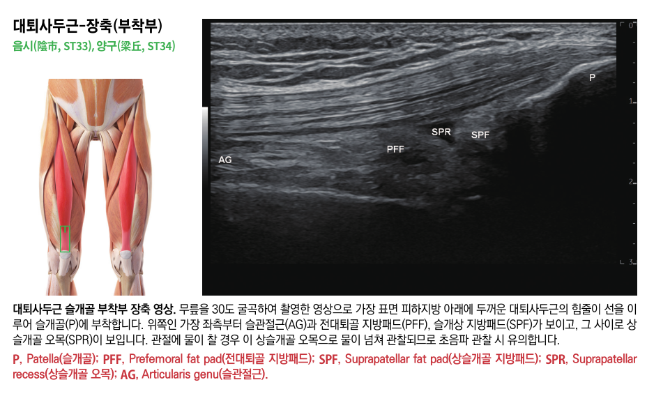 무릎을 30도 굽힌 상태에서 촬영한 대퇴사두근 슬개골 부착부의 장축 초음파 영상과 대퇴사두근 해부학적 그림 — 초음파 정밀 진단 | 서울 바로한의원 초음파 약침·도침·침도