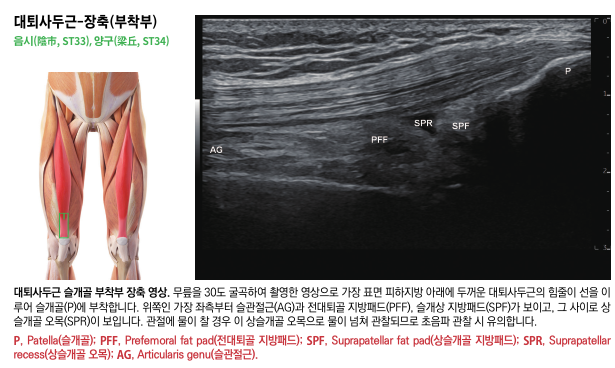 대퇴사두근 근육 해부도와 슬개골 부착부의 초음파 영상으로, 힘줄과 주변 지방패드가 보인다.