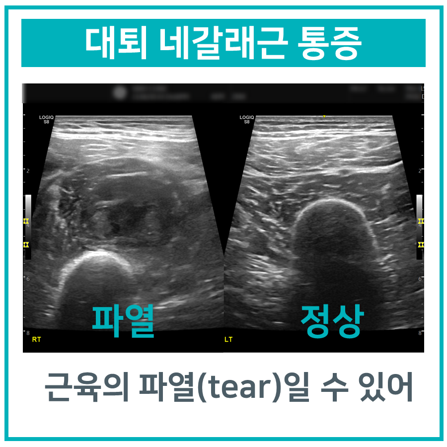대퇴 네갈래근의 파열과 정상 상태를 비교한 초음파 사진
