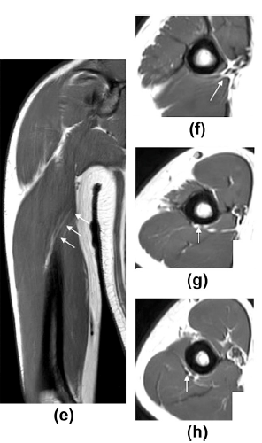 팔과 어깨 부위의 여러 MRI 영상으로, 요골신경으로 보이는 구조물에 화살표가 표시되어 있습니다.