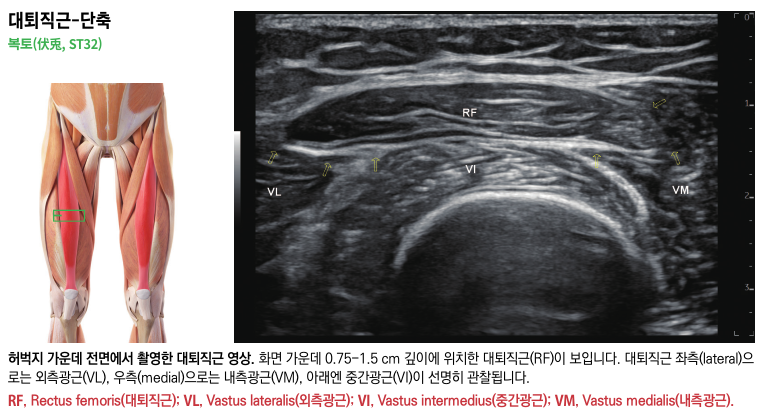 대퇴직근 해부도와 대퇴직근, 외측광근, 중간광근, 내측광근이 보이는 허벅지 초음파 영상 — 초음파 정밀 진단 | 서울 바로한의원 초음파 약침·도침·침도