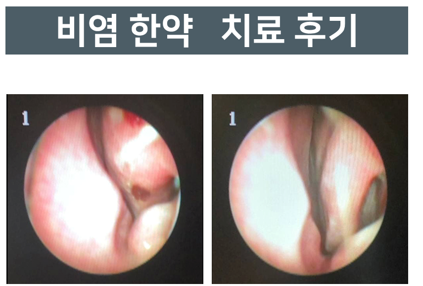 비염 한약 치료 전후 코 내부를 촬영한 내시경 사진.