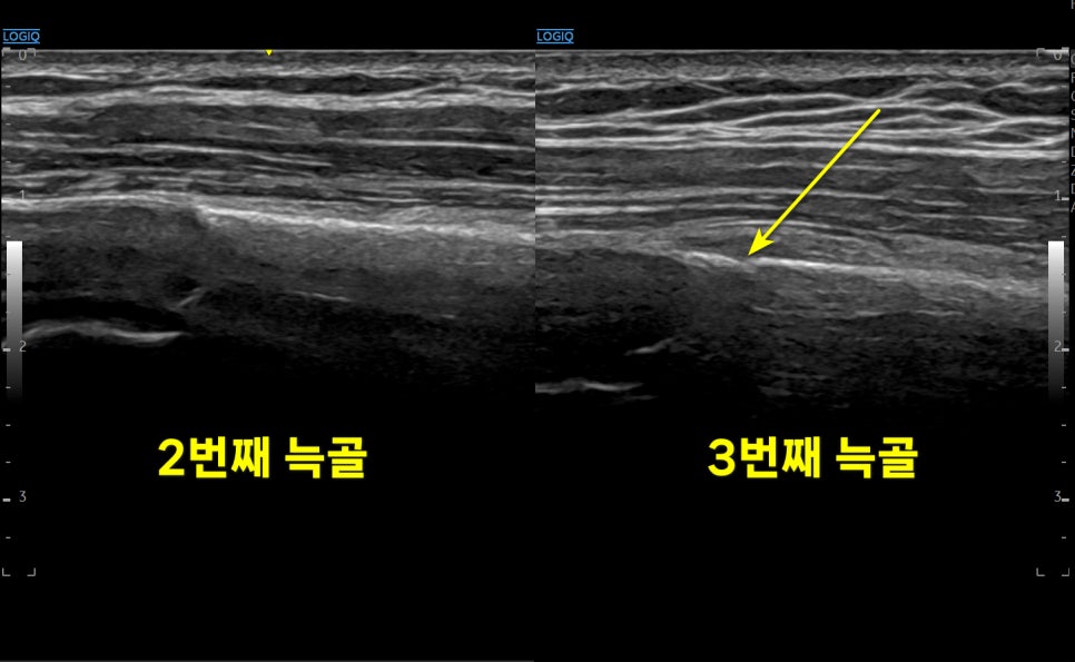2번 늑골과 3번 늑골의 초음파 영상으로, 3번 늑골 부위에 노란색 화살표가 표시되어 있다.