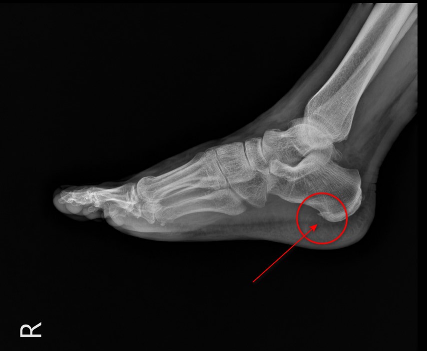 오른쪽 발 X-ray 사진으로, 발뒤꿈치뼈에 뼈 돌기가 빨간 원과 화살표로 표시되어 있습니다.
