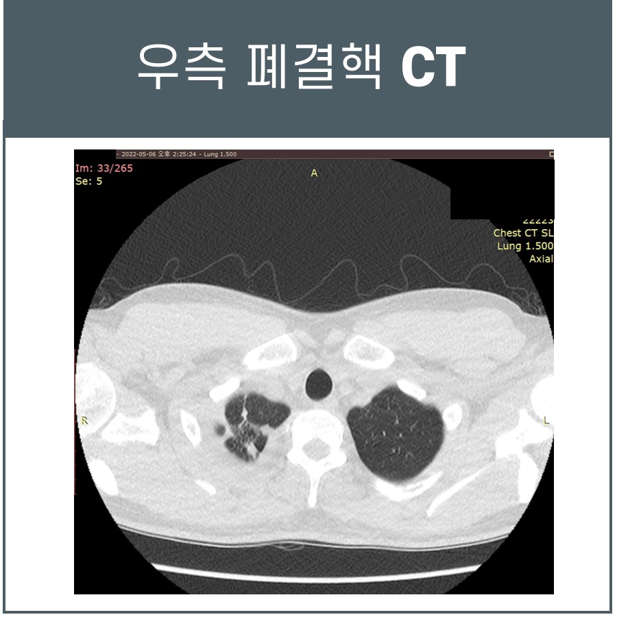 우측 폐결핵이 보이는 흉부 CT 영상.