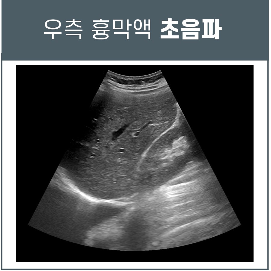 우측 흉막액 초음파 검사 이미지