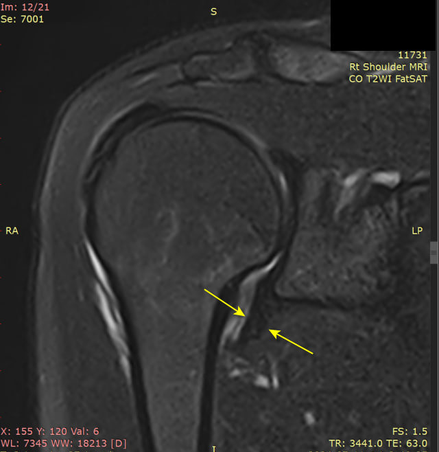 오른쪽 어깨 MRI 영상에서 노란색 화살표가 어깨 관절 주변의 염증 소견을 나타냅니다.