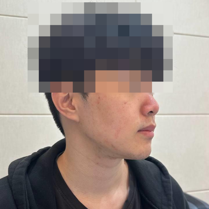 얼굴 옆모습에 코와 뺨에 붉은 기가 보이는 남성