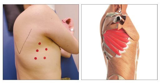 옆구리에 표시된 붉은 점과 톱니근(serratus anterior muscle) 해부학적 그림