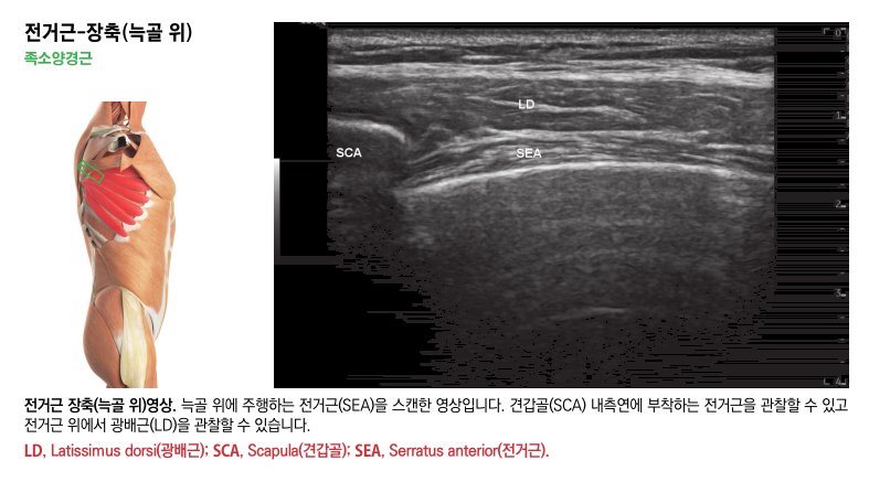 전거근 해부학 그림과 전거근, 광배근, 견갑골을 보여주는 초음파 영상.