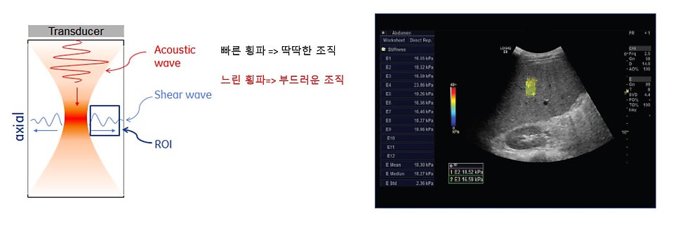 음파를 이용한 전단파 발생 및 조직 경도 측정 원리 다이어그램과 복부 장기 초음파 영상 및 경도 측정값이 표시된 화면 — 초음파 정밀 진단 | 서울 바로한의원 초음파 약침·도침·침도
