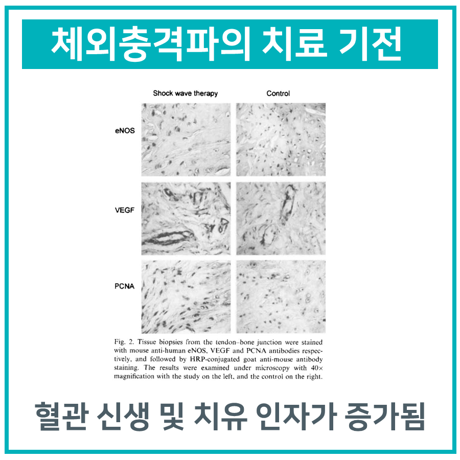 체외충격파 치료 후 힘줄-뼈 접합부 조직에서 eNOS, VEGF, PCNA 발현을 비교한 현미경 사진 — 서울 바로한의원 초음파 약침·도침