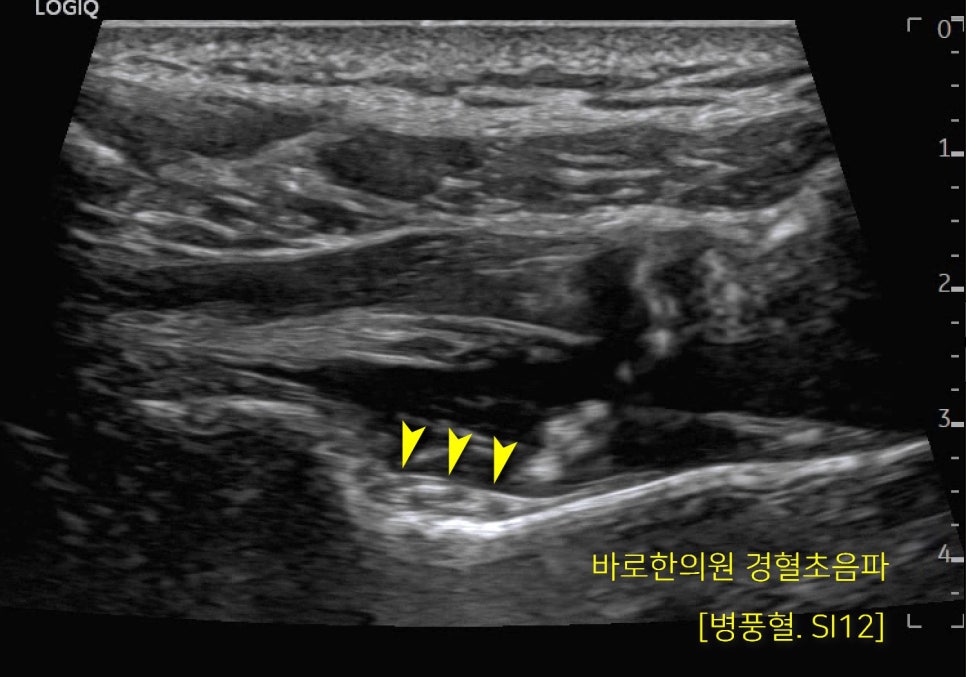 어깨 부위 경혈 SI12(병풍혈)의 초음파 사진입니다.