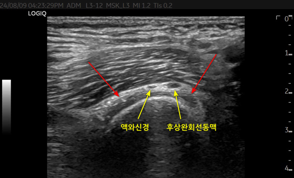 어깨 부위의 액와신경과 후상완회선동맥을 보여주는 초음파 사진