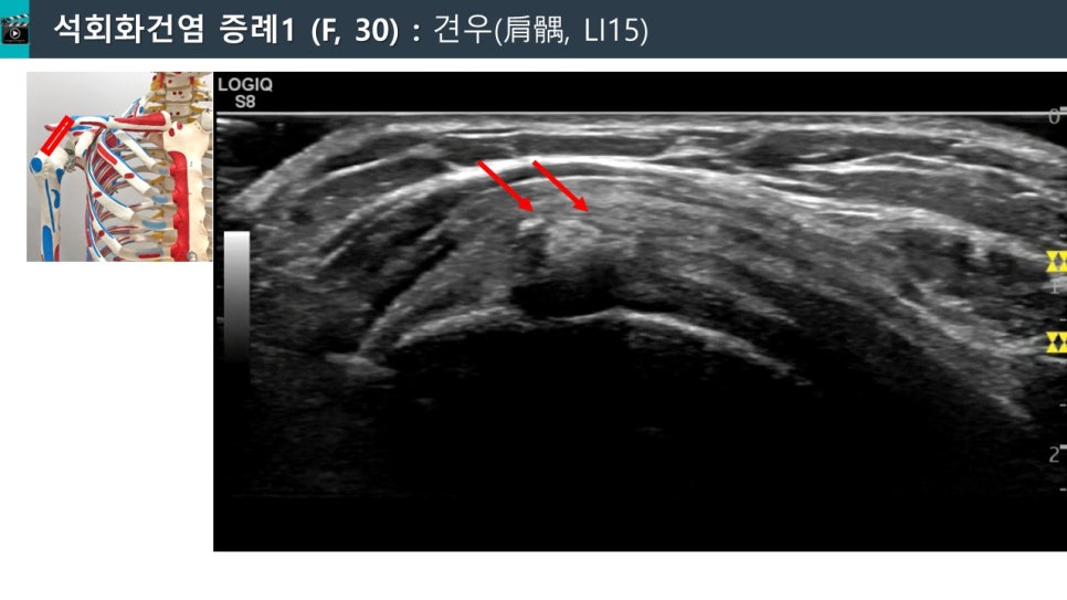 어깨 힘줄에 석회 침착물이 붉은 화살표로 표시된 초음파 사진과 어깨 관절 해부학 모형.