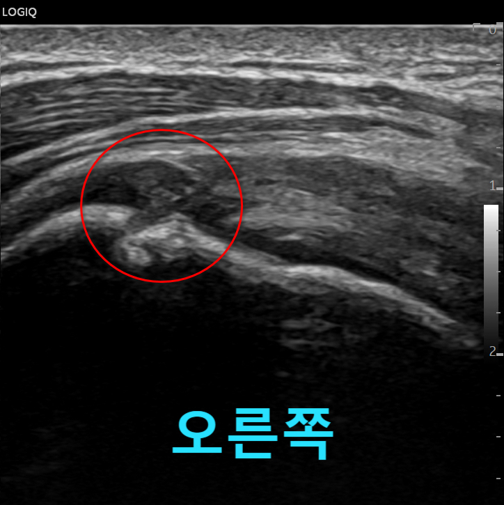 어깨 앞쪽을 촬영한 초음파 사진으로, 빨간색 원 안에 특정 부위가 표시되어 있고 하단에 '오른쪽'이라는 글자가 있다.