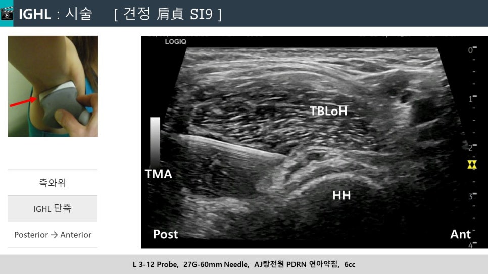 어깨에 초음파 탐촉자를 대고 바늘을 삽입하는 초음파 영상과 시술 사진