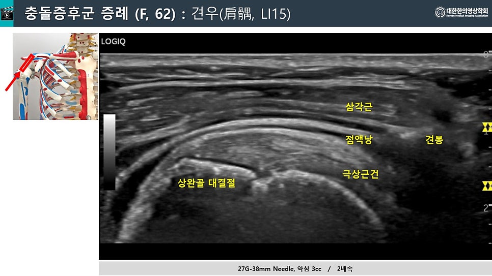 어깨충돌증후군 해부학적 그림과 어깨 초음파 영상으로 삼각근, 견봉, 점액낭, 극상건, 상완골 대결절이 표시되어 있습니다.