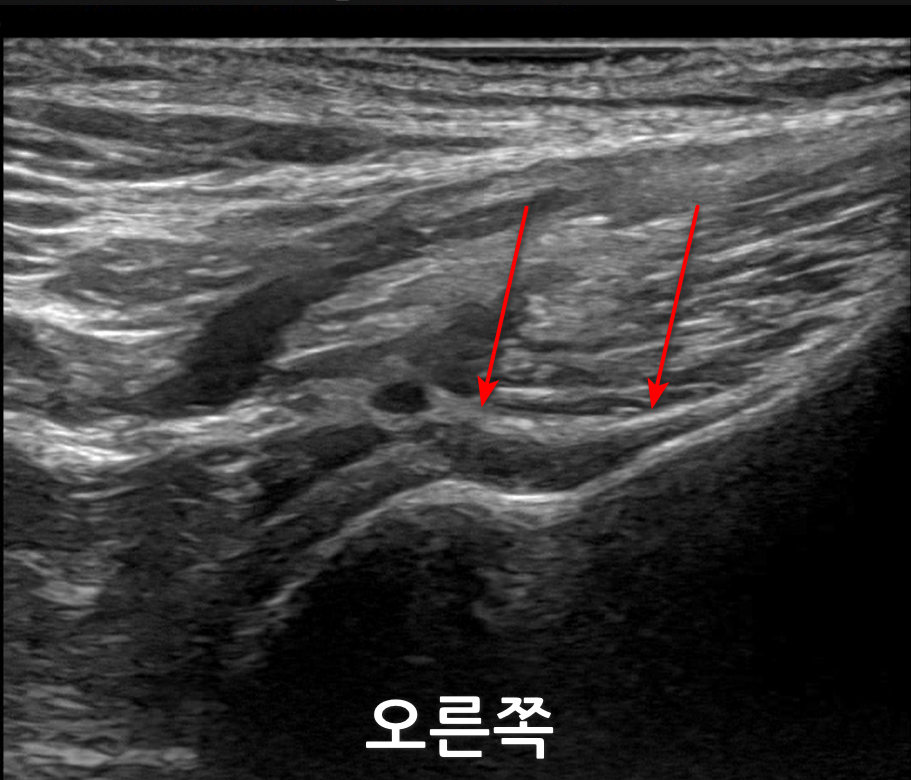 어깨 초음파 사진에서 빨간 화살표가 어깨 부위의 특정 조직을 가리키고 있다.