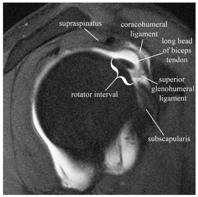 어깨 관절 MRI 영상으로, 회전근개 간격과 주변 인대, 힘줄 등 해부학적 구조가 표시되어 있습니다.