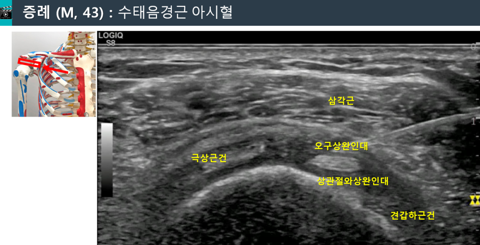 어깨 관절의 삼각근, 극상근건 등이 표시된 초음파 영상과 어깨 해부학 모형.