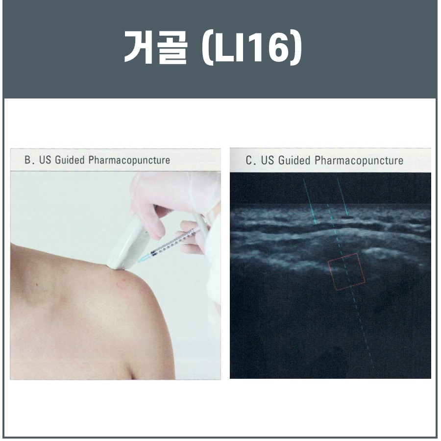 어깨에 초음파 유도 하에 약침 시술을 하는 모습과 초음파 영상 — 초음파 유도하 약침 시술 | 서울 바로한의원
