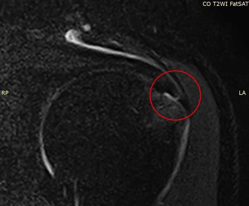 어깨 MRI 영상에 빨간색 원으로 특정 부위가 표시되어 있다.