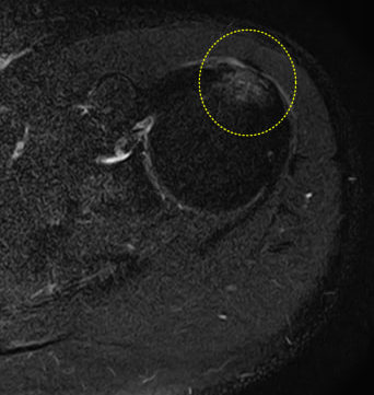 어깨 관절의 자기공명영상(MRI)으로, 노란색 점선 원이 특정 부위를 강조하고 있다.