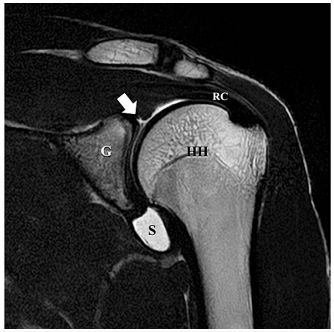 어깨 관절의 MRI 영상으로, 화살표가 관절와순 상부를 가리키고 있다.