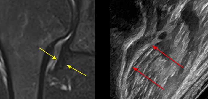 어깨 관절의 MRI 영상과 초음파 영상이 나란히 비교되어 있으며, 각 영상에 화살표로 특정 부위가 표시되어 있다.