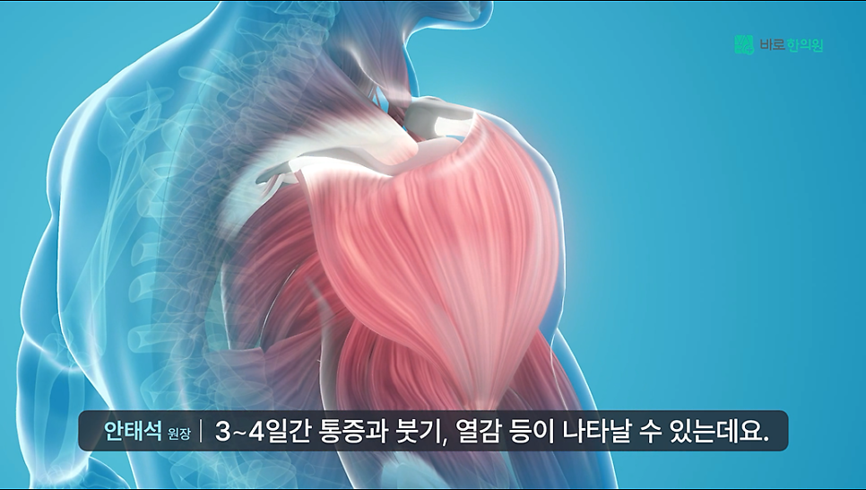 3D 인체 모형으로 어깨와 팔 근육을 보여주는 이미지