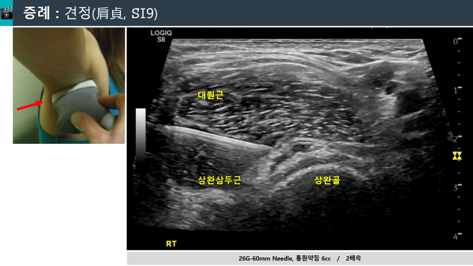 어깨 부위에 초음파 탐촉자를 대고 초음파 영상으로 대원근, 상완삼두근, 상완골 주변에 바늘이 삽입된 모습을 보여주는 사진.