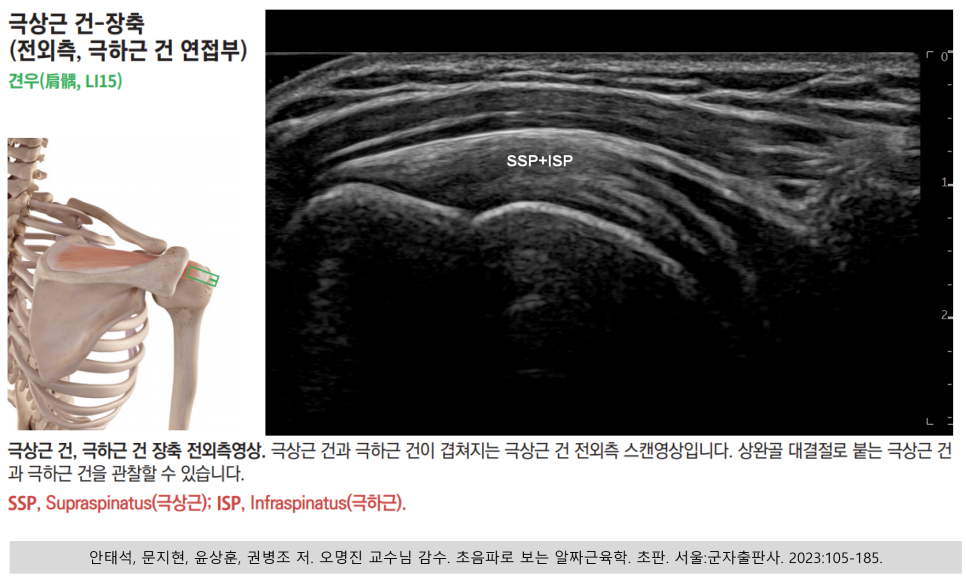 극상근 증후군 통증? 스트레칭으로 안 풀리면 읽어보세요