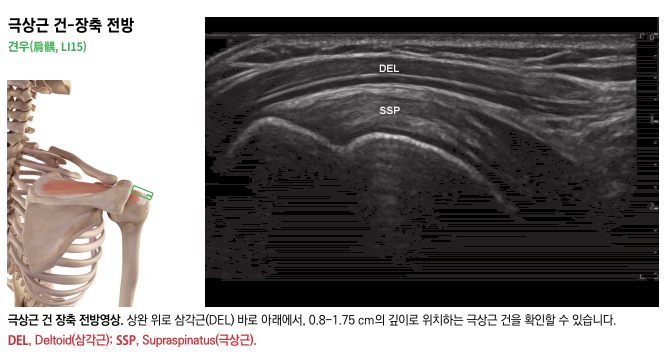 어깨뼈와 팔뼈가 보이는 어깨 해부학 그림과 어깨 삼각근(DEL) 및 극상근(SSP)이 표시된 초음파 영상.