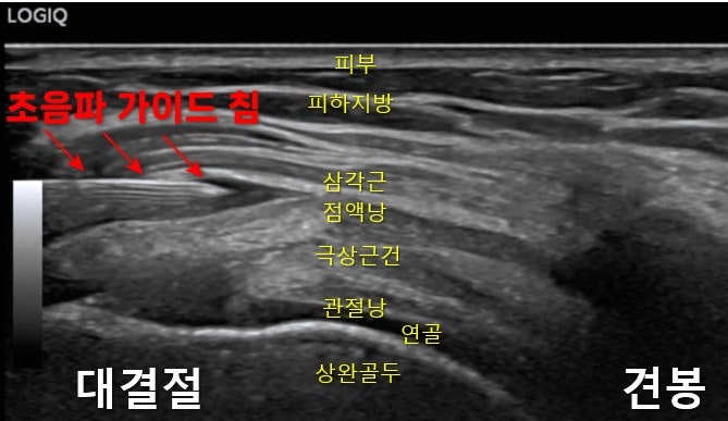 어깨 초음파 영상으로, 초음파 유도 하에 삽입된 침과 주변 해부학적 구조(피부, 피하지방, 삼각근, 점액낭, 극상건, 관절낭, 연골, 상완골두, 대결절, 견봉)가 표시되어 있습니다.