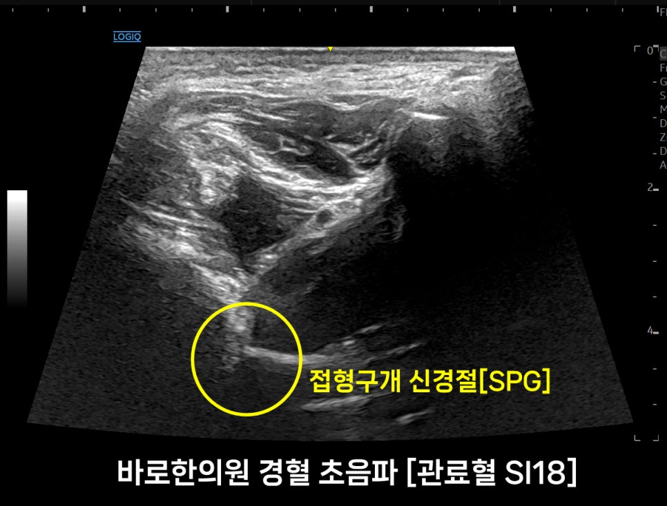 관료혈(SI18) 부위의 접형구개 신경절(SPG)을 보여주는 초음파 이미지