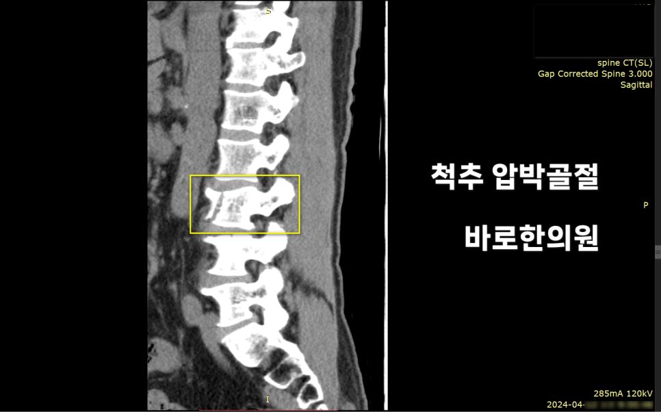 척추 압박골절이 보이는 척추 CT 영상