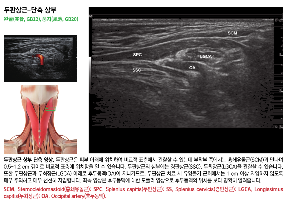 목 부위의 두판상근 해부학적 그림과 함께 두판상근, 경판상근, 후두동맥을 보여주는 초음파 영상들이 포함된 이미지.