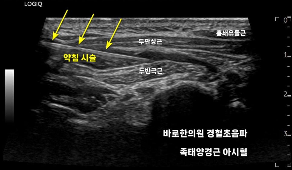 두판상근과 두반극근에 약침 시술이 진행되는 경혈 초음파 사진
