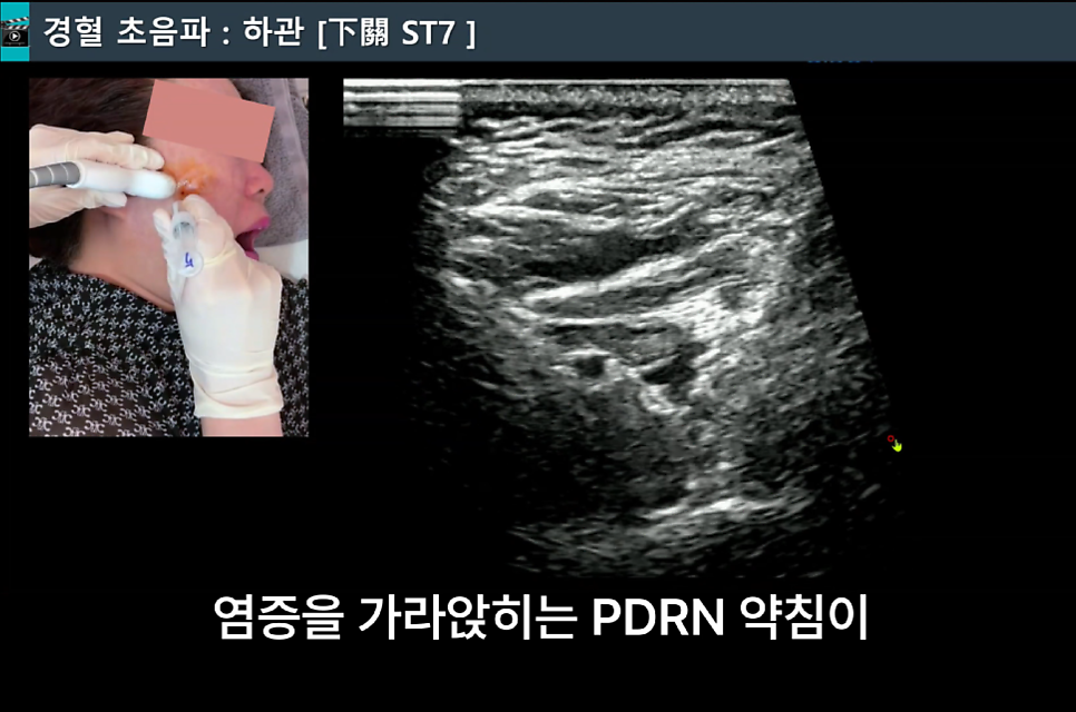 얼굴에 초음파 가이드 약침 시술을 하는 모습과 초음파 화면
