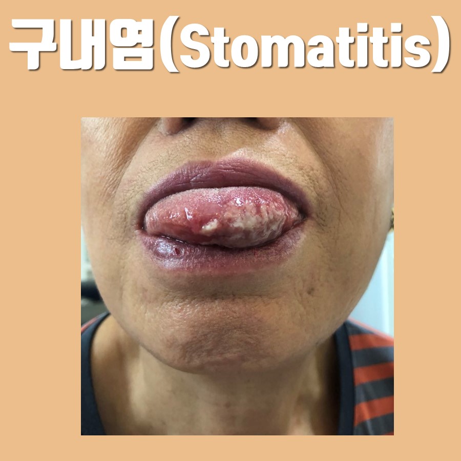 혀에 하얗고 염증이 있는 구내염이 발생한 입술과 혀의 클로즈업 사진.
