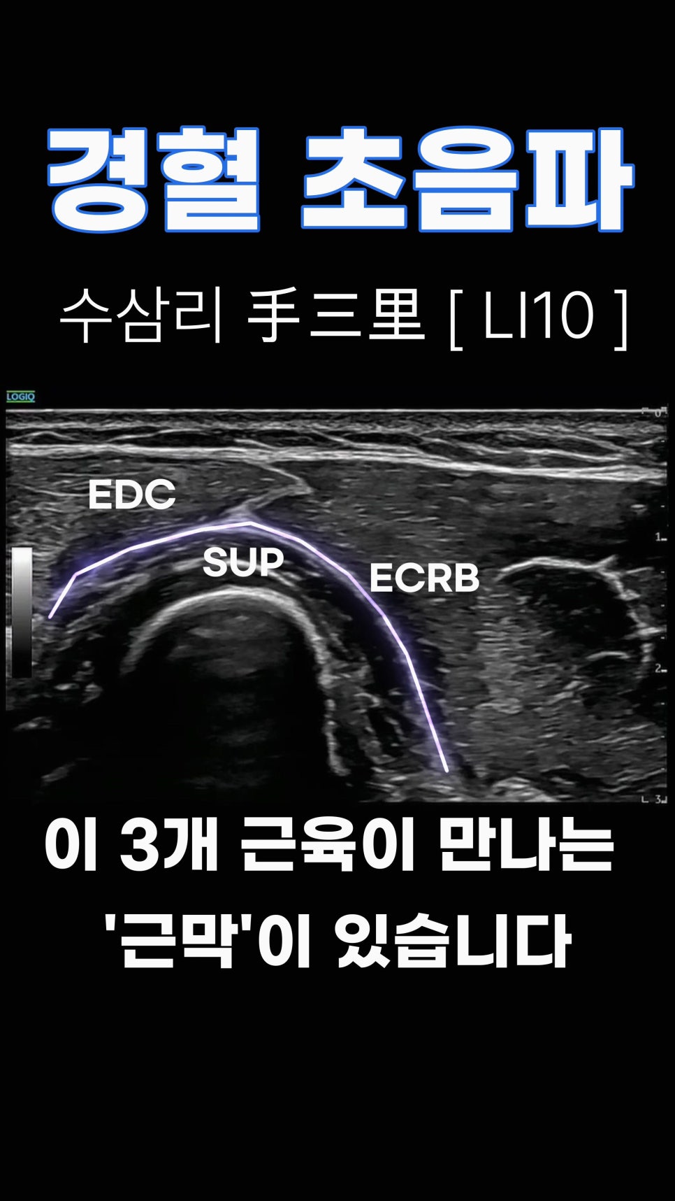 수삼리(LI10) 혈자리 주변의 EDC, SUP, ECRB 근육과 근막을 보여주는 초음파 영상
